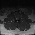 Normal lumbar spine MRI (Radiopaedia 47857-52609 Axial T1 2).jpg