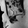 Normal prostate (MRI) (Radiopaedia 29986-30535 Sagittal T2 17).jpg