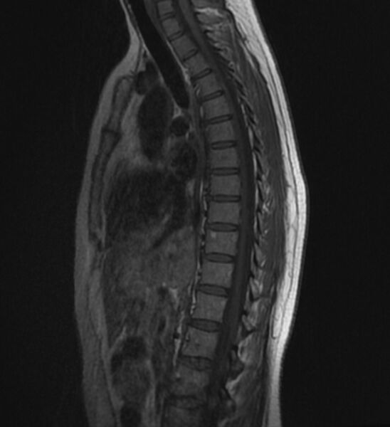 File:Normal thoracic spine MRI (Radiopaedia 41033-43781 Sagittal T1 6).jpg