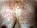 Purpura due to amyloidosis (DermNet NZ systemic-amyloid5).jpg