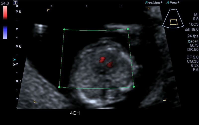 File:1st trimester nuchal-morphology ultrasound (Radiopaedia 44706-48477 Heart views cine with colour 60).jpg