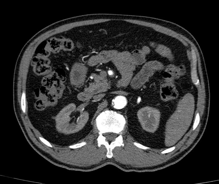 File:Abdominal aortic aneurysm (Radiopaedia 22421-22458 C+ arterial phase 25).jpg