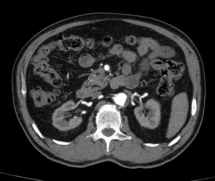File:Abdominal aortic aneurysm (Radiopaedia 22421-22458 C+ arterial phase 29).jpg