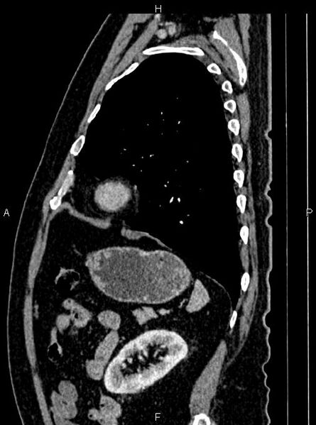 File:Abdominal aortic aneurysm (Radiopaedia 83094-97462 Sagittal renal cortical phase 93).jpg
