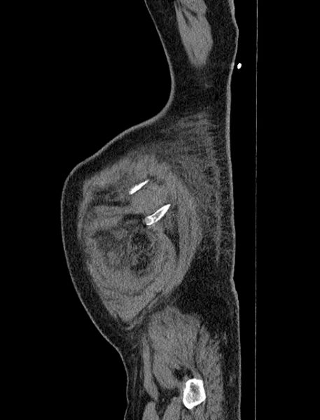 File:Abdominal aortic aneurysm rupture (Radiopaedia 54179-60362 Sagittal C+ arterial phase 45).jpg