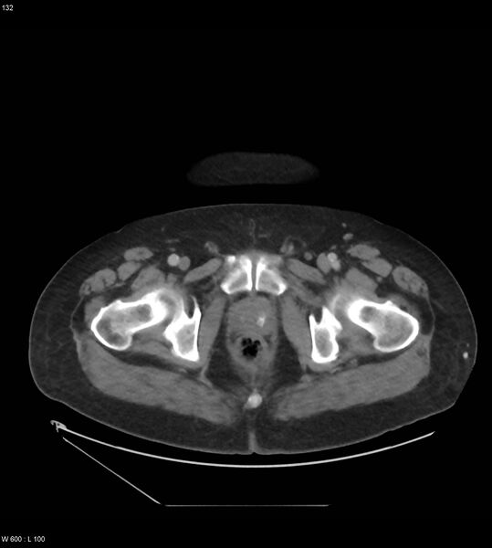 File:Abdominal aortic aneurysm with intramural hematoma then rupture (Radiopaedia 50278-55631 Axial C+ arterial phase 123).jpg