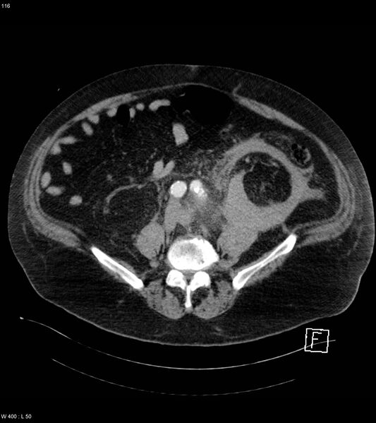 File:Abdominal aortic aneurysm with intramural hematoma then rupture (Radiopaedia 50278-55632 Axial C+ arterial phase 115).jpg