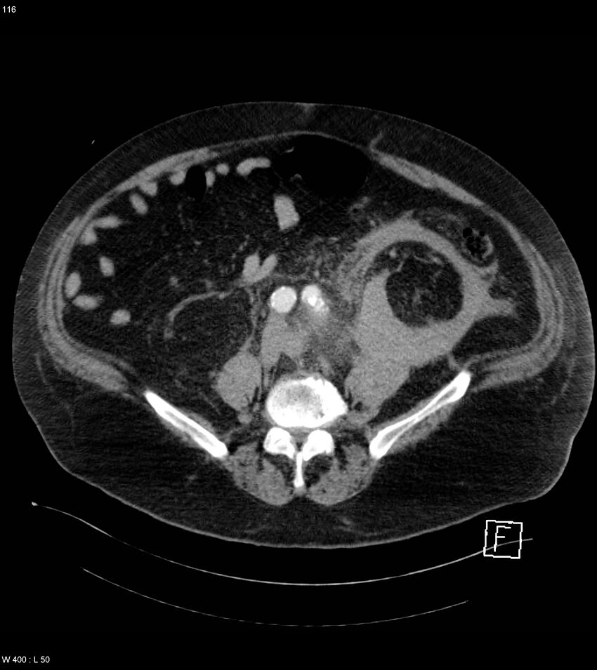 Abdominal aortic aneurysm with intramural hematoma then rupture (Radiopaedia 50278-55632 Axial C+ arterial phase 115).jpg