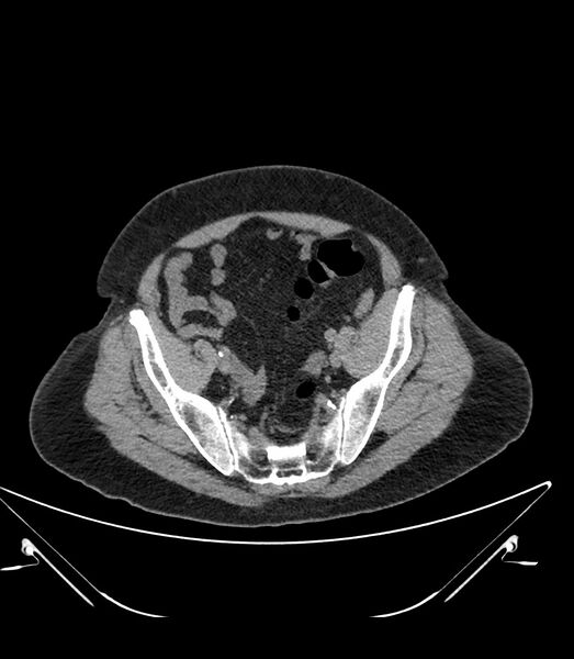 File:Abdominal aortic aneurysm with thrombus fissuration (Radiopaedia 46218-50618 Axial non-contrast 46).jpg