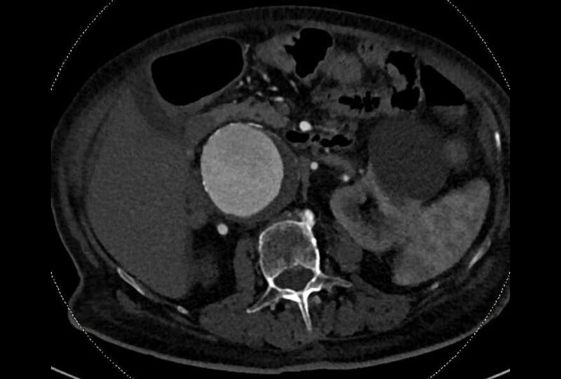 File:Abdominal aortic aneurysm with thrombus fissuration (Radiopaedia 73192-83919 Axial C+ arterial phase 60).jpg
