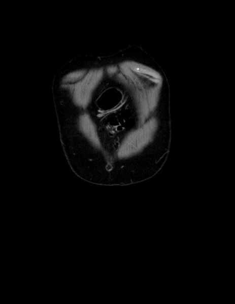 File:Abdominal lymphoma - with sandwich sign (Radiopaedia 53486-59492 C+ portal venous phase 57).jpg