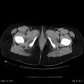 Abdominal wall endometriosis (Radiopaedia 25723-25885 Axial C+ portal venous phase 41).jpg
