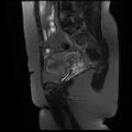 Abdominal wall endometriosis (Radiopaedia 83702-98847 Sagittal T2 fat sat 12).jpg