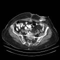 Abdominal wall recurrence after colorectal resection for cancer (Radiopaedia 23444-23523 Axial C+ portal venous phase 28).jpg