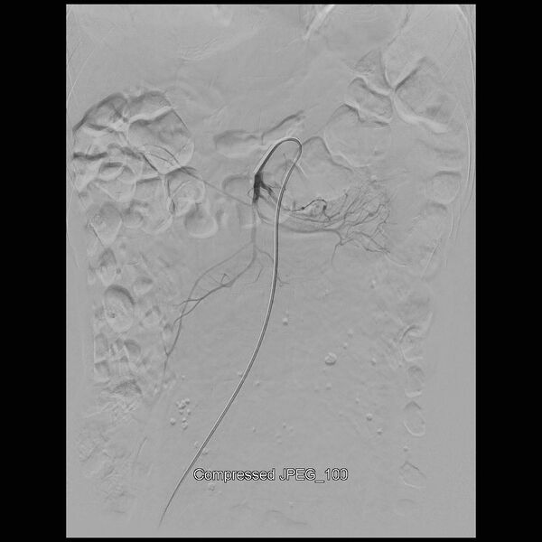 File:Abernethy malformation (Radiopaedia 42006-45462 Frontal Superior mesenteric artery 3).jpg