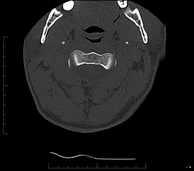 File:Accessory articulation of cervical transverse processes (Radiopaedia 82715-96933 Axial non-contrast 28).jpg