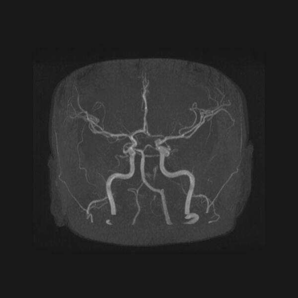 File:Accessory middle cerebral artery and ICA aneurysm (Radiopaedia 22656-22674 B 4).jpg