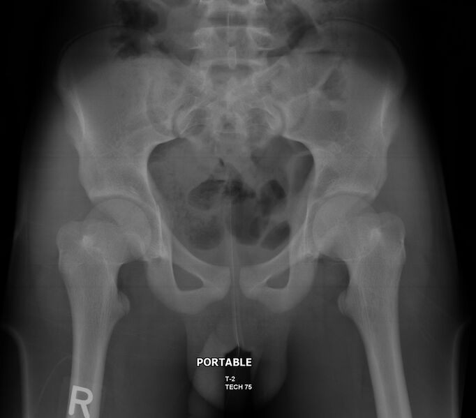 File:Acetabular fracture (Radiopaedia 13285-13287 Frontal 1).jpg