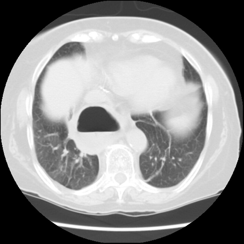 Achalasia (Radiopaedia 44094-47649 Axial lung window 44).jpg