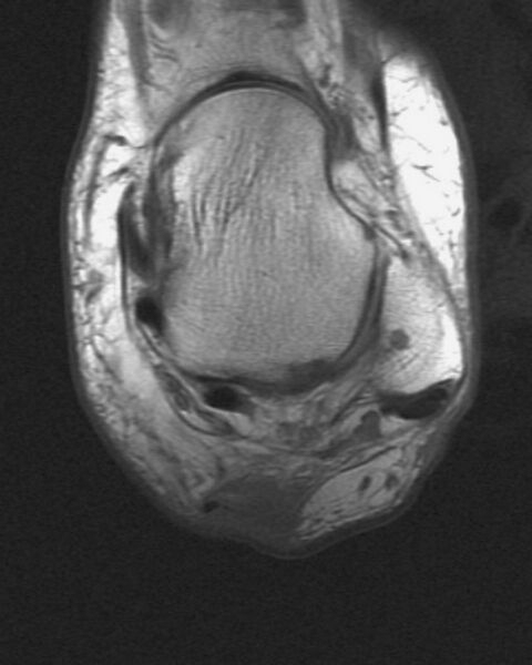File:Achilles tendon tear (Radiopaedia 2572-6268 Axial T1 1).jpg