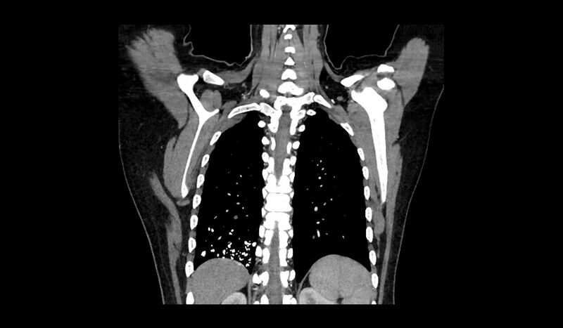 File:Acquired tracheo-esophageal fistula (Radiopaedia 51356-57103 Coronal C+ arterial phase 3).jpg
