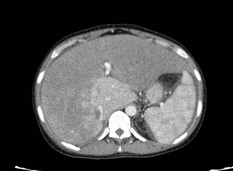 File:Acute Budd-Chiari syndrome (Radiopaedia 60858-68638 Axial C+ portal venous phase 72).jpg