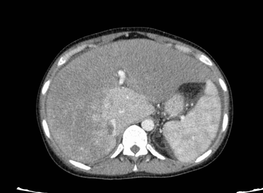 Acute Budd-Chiari syndrome (Radiopaedia 60858-68638 Axial C+ portal venous phase 72).jpg