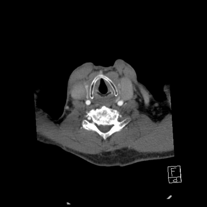 Acute ICA ischemic penumbra due to high-grade CCA stenosis (CT perfusion) (Radiopaedia 72038-82530 Axial C+ arterial phase 58).jpg