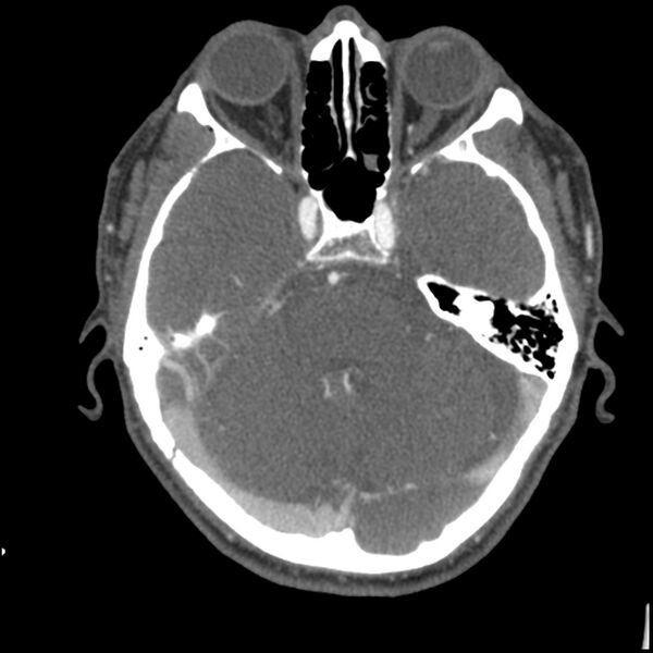 File:Acute P1 occlusion with PCA ischemia penumbra (CT perfusion) (Radiopaedia 72084-82587 Axial C+ arterial thins 71).jpg