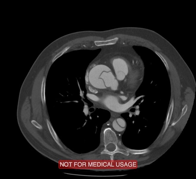 File:Acute aortic dissection - Stanford type A (Radiopaedia 40661-43285 Axial C+ arterial phase 33).jpg