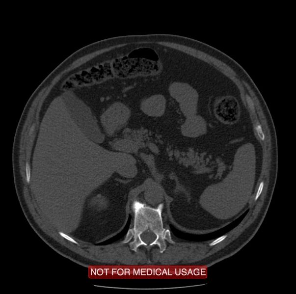 File:Acute aortic dissection - Stanford type A (Radiopaedia 40661-43285 Axial non-contrast 86).jpg