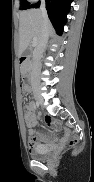 File:Acute appendicitis (Radiopaedia 62608-70901 Sagittal C+ portal venous phase 28).jpg