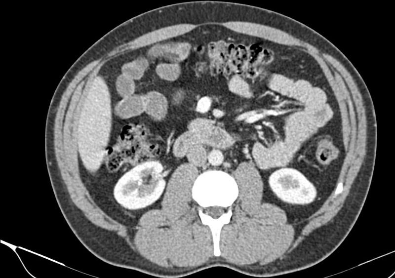 File:Acute diverticulitis - Hinchey stage Ia (Radiopaedia 82071-96095 Axial C+ arterial phase 45).jpg