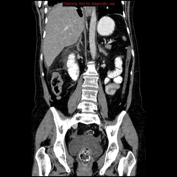 File:Acute gangrenous cholecystitis (Radiopaedia 10123-10661 Coronal C+ portal venous phase 25).jpg