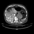 Acute heart failure (CT) (Radiopaedia 79835-93075 Axial C+ arterial phase 77).jpg