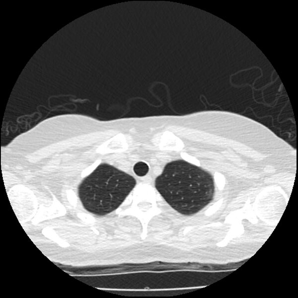 File:Acute interstitial pneumonitis (Radiopaedia 45404-49444 Axial lung window 12).jpg
