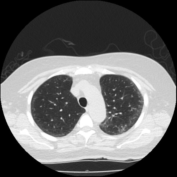 File:Acute interstitial pneumonitis (Radiopaedia 45404-49444 Axial lung window 29).jpg