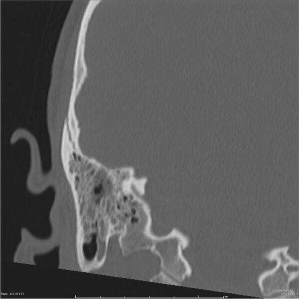File:Acute otomastoiditis (Radiopaedia 28276-28512 Coronal PTB bone window reformat 44).jpg