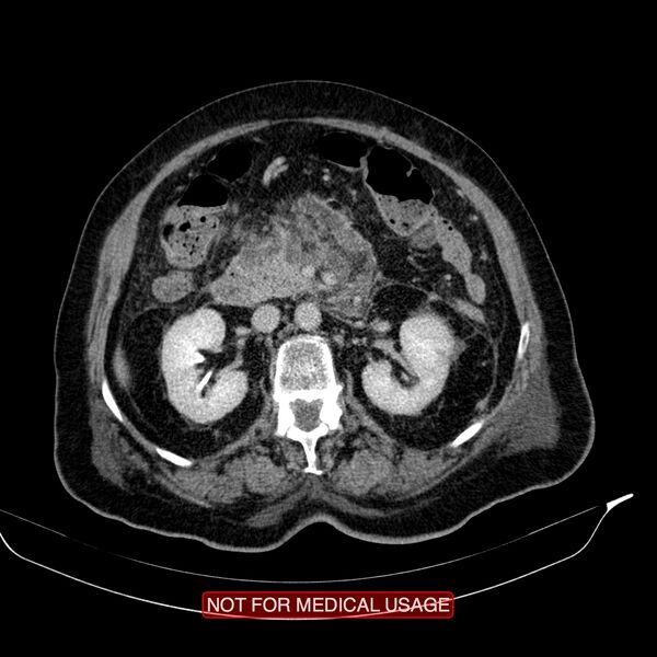 File:Acute pancreatitis with infected necrosis (Radiopaedia 26454-26585 Axial C+ delayed 16).jpg