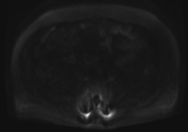 File:Acute portal vein thrombosis (Radiopaedia 73198-83925 Axial DWI 86).jpg