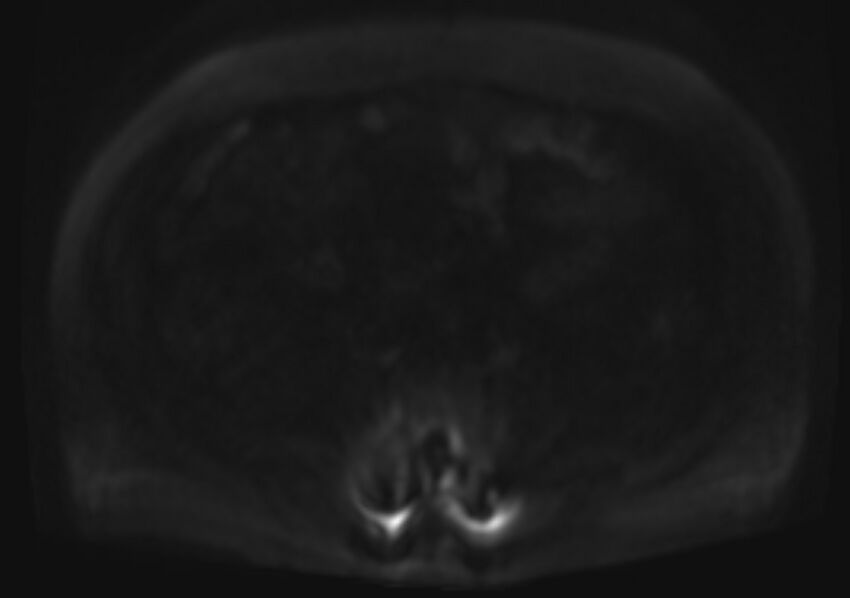 Acute portal vein thrombosis (Radiopaedia 73198-83925 Axial DWI 86).jpg
