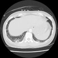 Acute pulmonary edema on CT (Radiopaedia 33582-34672 Axial lung window 47).jpg