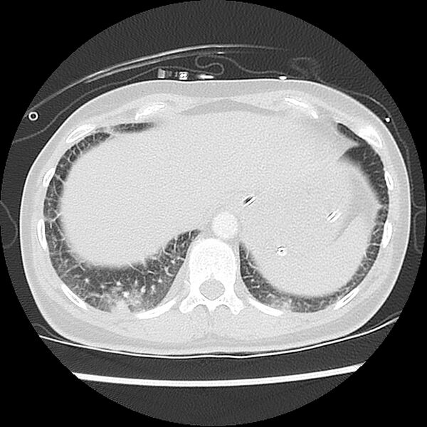 File:Acute pulmonary edema on CT (Radiopaedia 33582-34672 Axial lung window 47).jpg