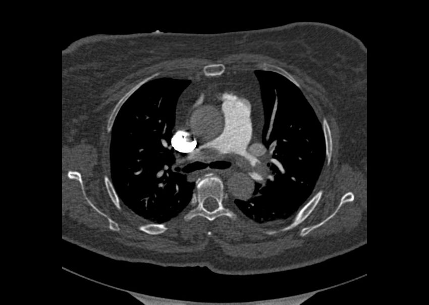 Acute pulmonary embolism (Radiopaedia 29938-30466 Axial C+ CTPA 43).jpg