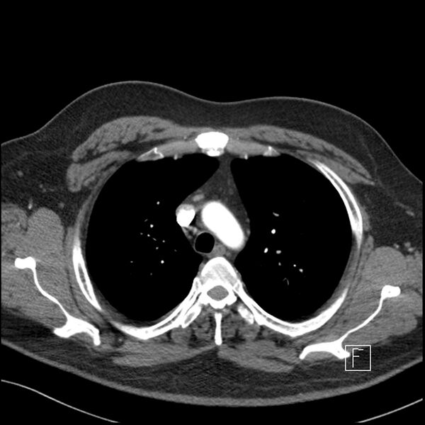 File:Acute pulmonary embolism with pulmonary infarct (Radiopaedia 73062-83768 Axial C+ CTPA 18).jpg