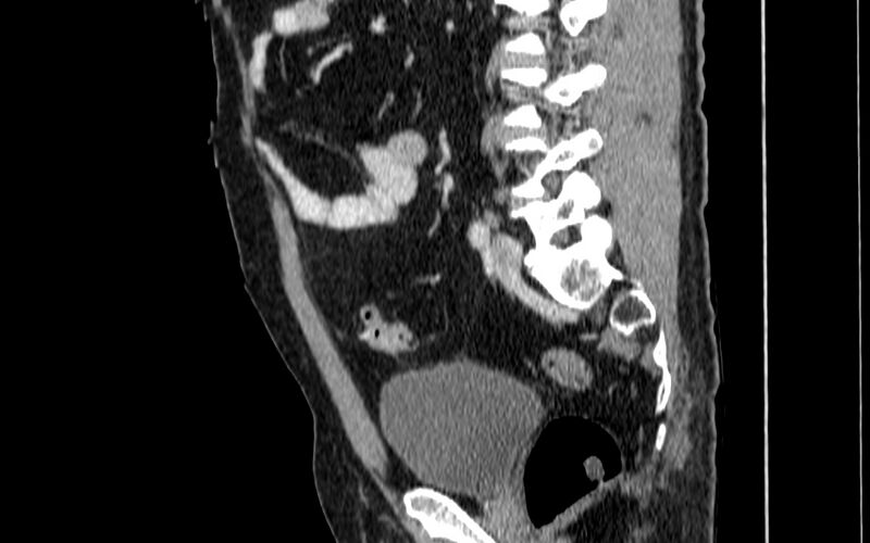 File:Acute sigmoid colon diverticulitis (Radiopaedia 55507-61976 Sagittal C+ portal venous phase 23).jpg