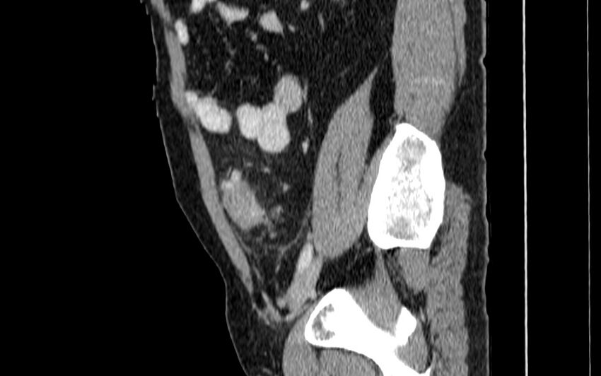 Acute sigmoid colon diverticulitis (Radiopaedia 55507-61976 Sagittal C+ portal venous phase 66).jpg