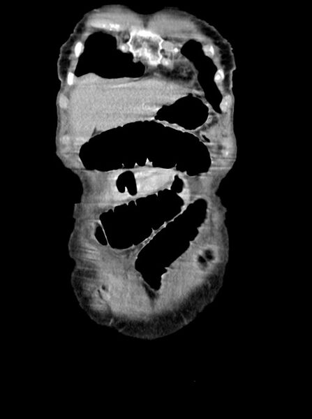 File:Acute small bowel (ileal) volvulus (Radiopaedia 71740-82139 Coronal C+ portal venous phase 16).jpg
