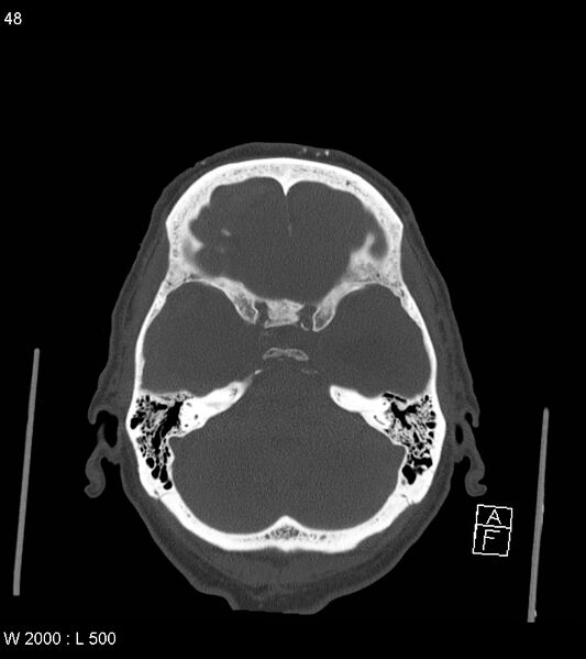 File:Acute subdural hematoma with myelofibrosis (Radiopaedia 52582-58494 Axial bone window 24).jpg