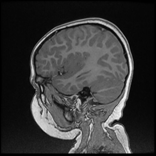 File:Adamantinomatous craniopharyngioma (Radiopaedia 77407-89529 Sagittal T1 C+ 101).jpg